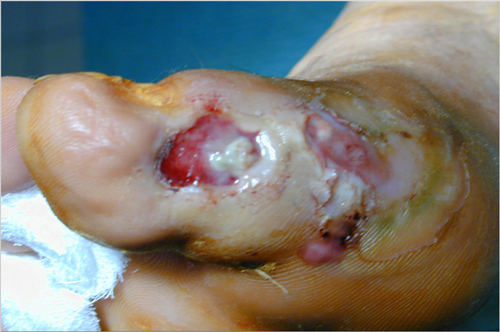 http://lnx.endocrinologiaoggi.it/wp-content/uploads/2011/06/osteomielite.jpg